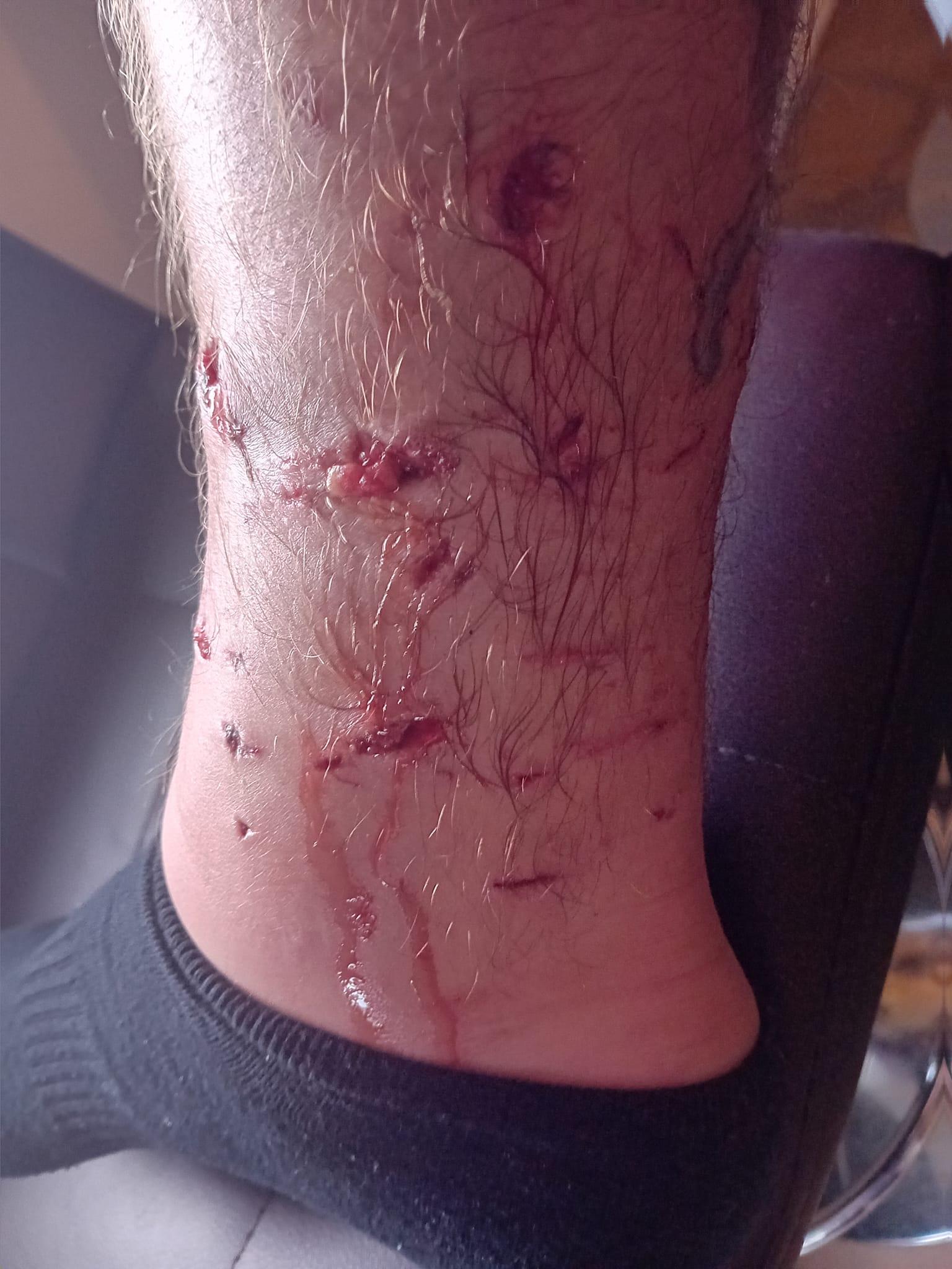 被狗咬傷|38歲英國男子Ben Cźyżyk腳部被咬出血洞。(Ben Cźyżyk facebook)