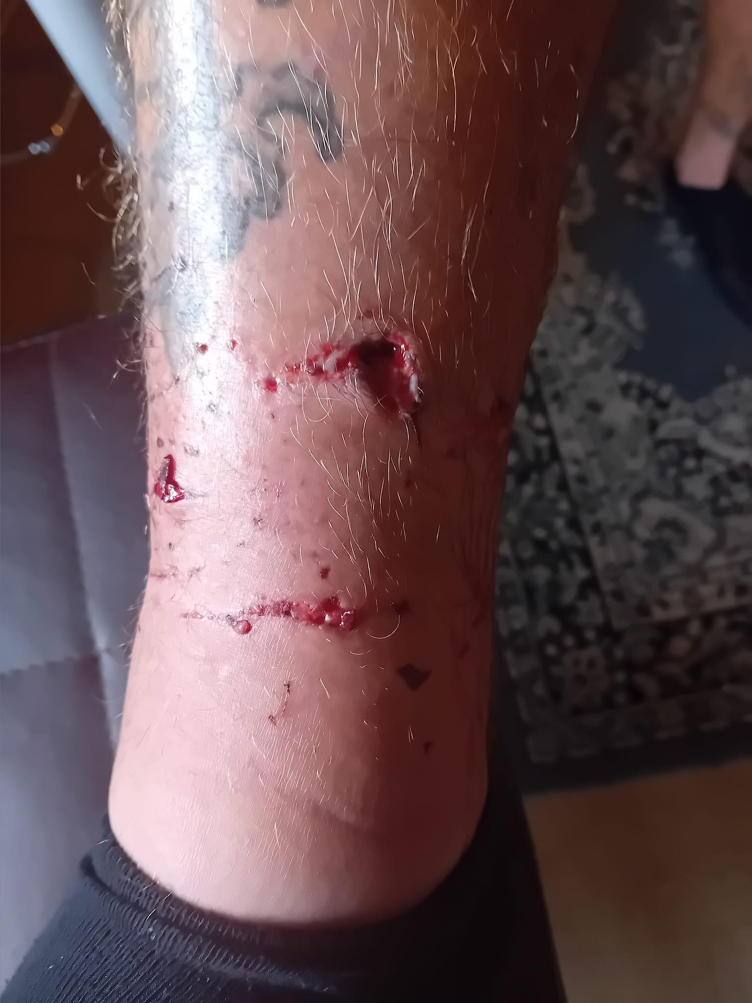 被狗咬傷|38歲英國男子Ben Cźyżyk腳部被咬出血洞。(Ben Cźyżyk facebook)