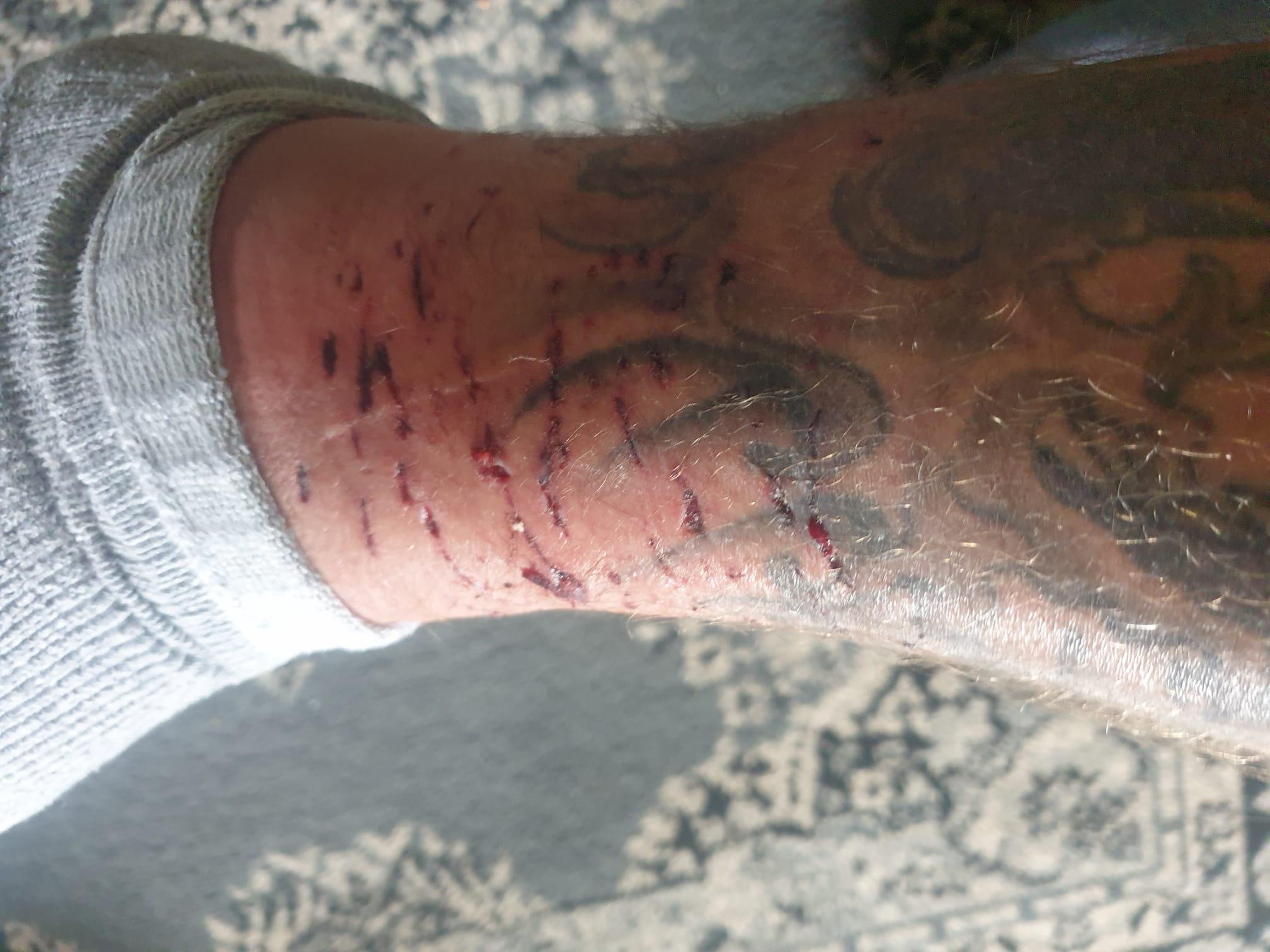 被狗咬傷|38歲英國男子Ben Cźyżyk周身傷。(Ben Cźyżyk facebook)