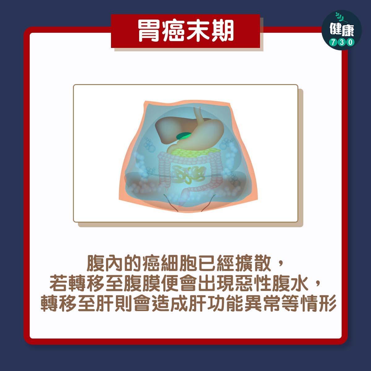 癌症|胃癌症狀(am730製圖)