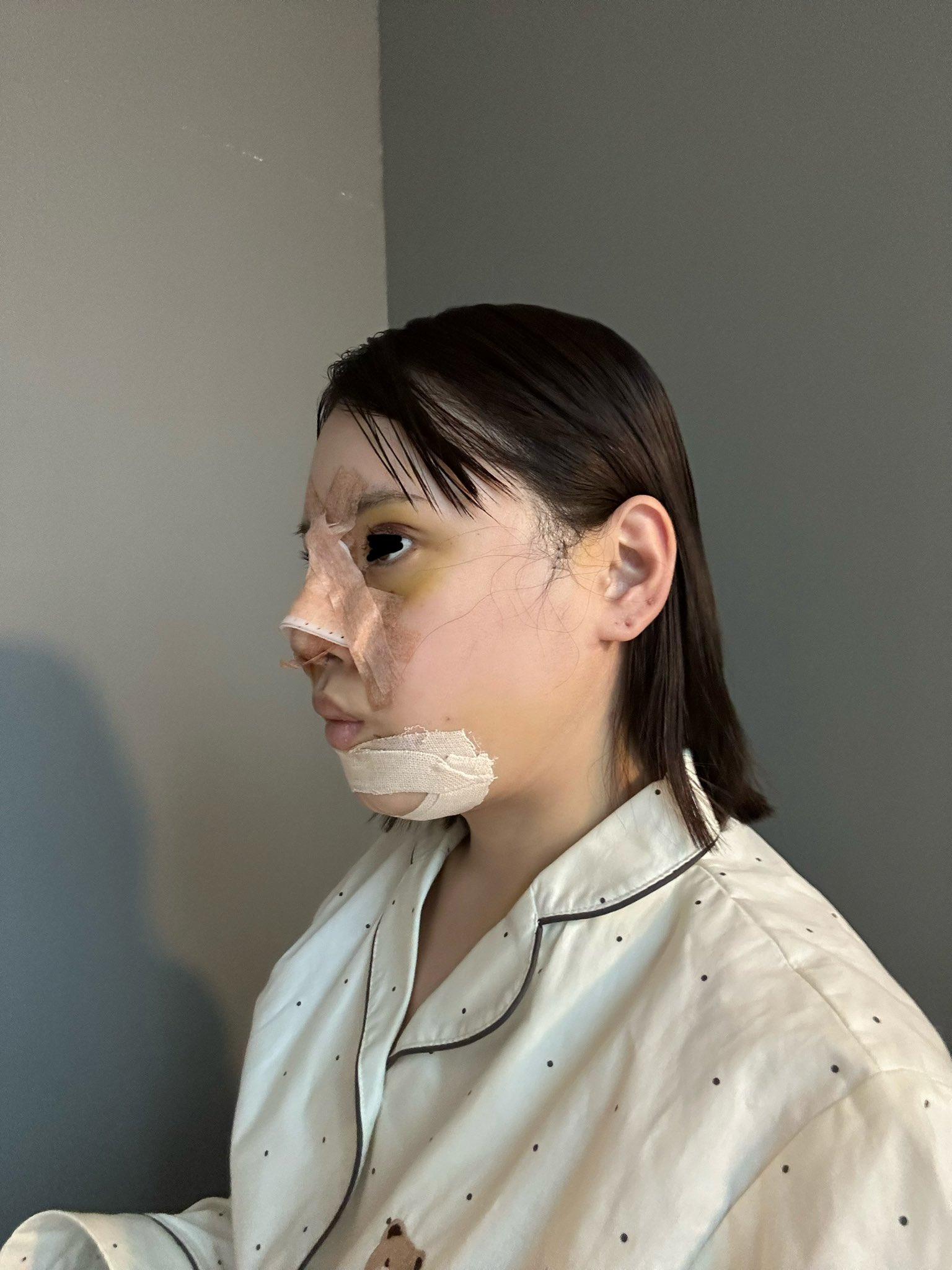 整容|日本網紅かりんKarin整形前外表。(karinntter X)