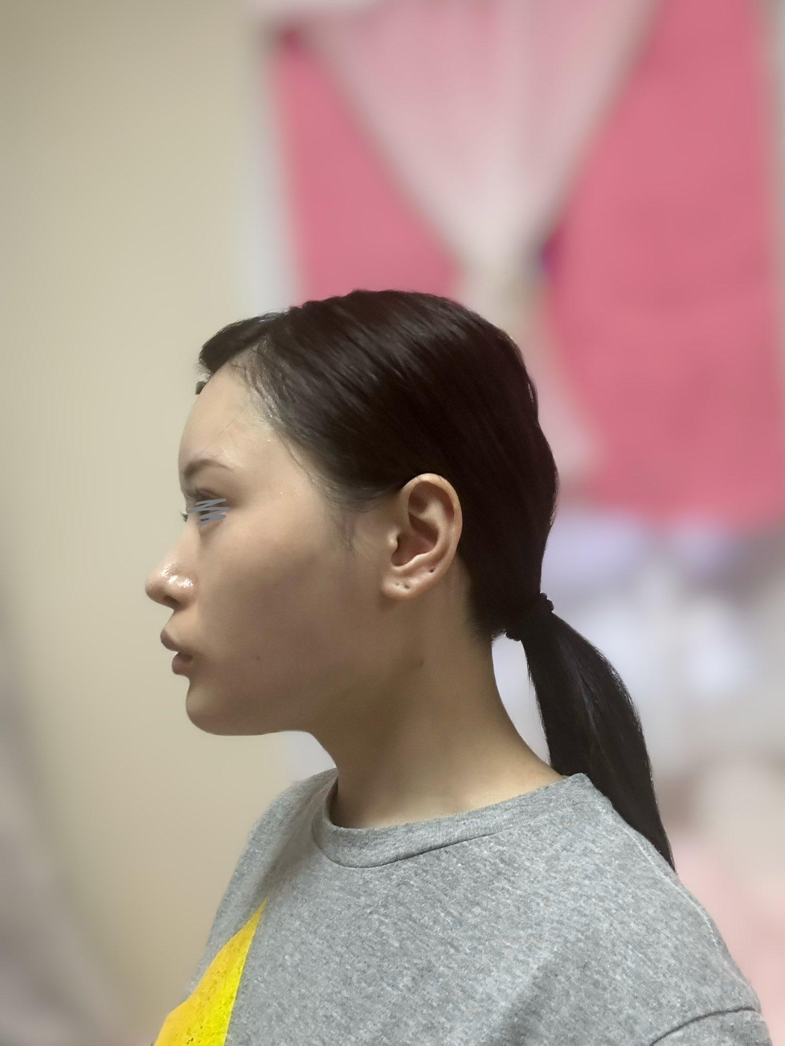 整容|日本網紅かりんKarin整形前外表。(karinntter X)