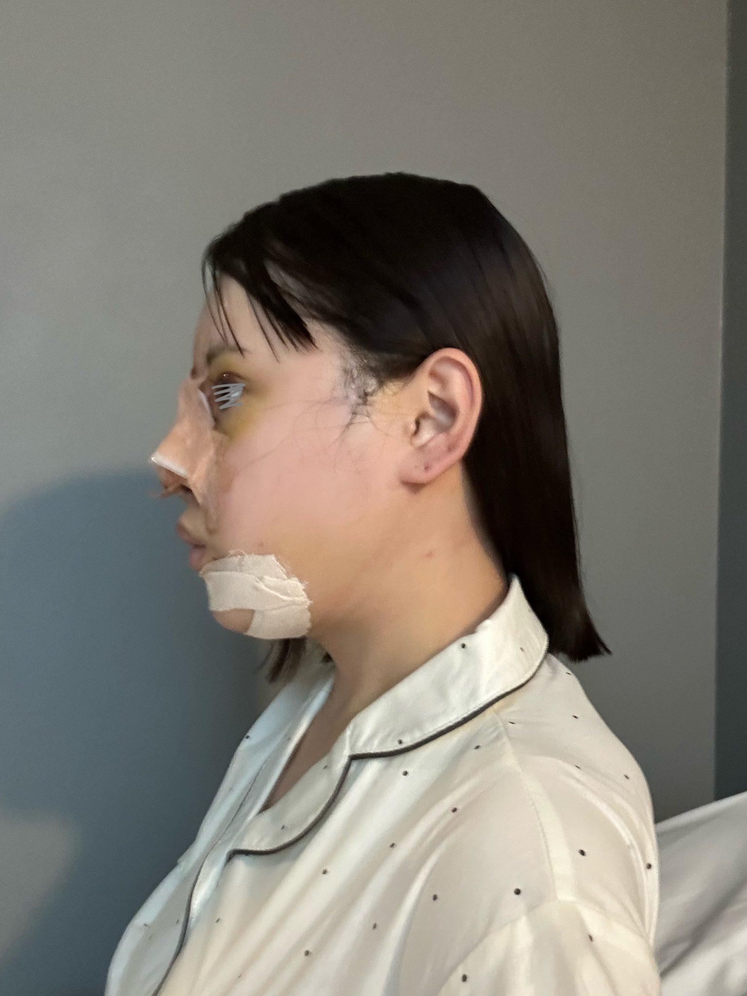 整容|日本網紅かりんKarin整形前外表。(karinntter X)