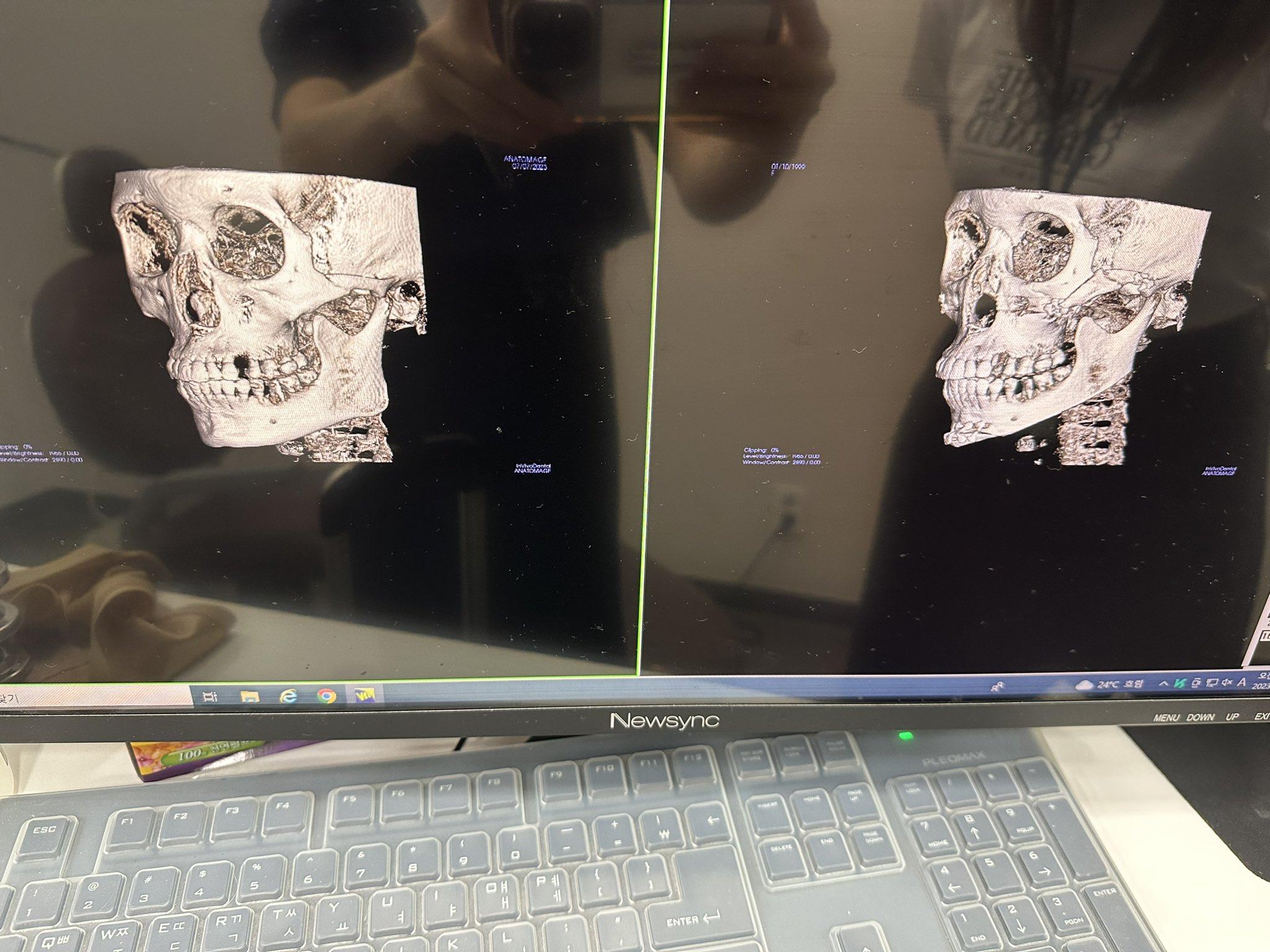 整容|日本網紅かりんKarin整形前後分別。(karinntter X)