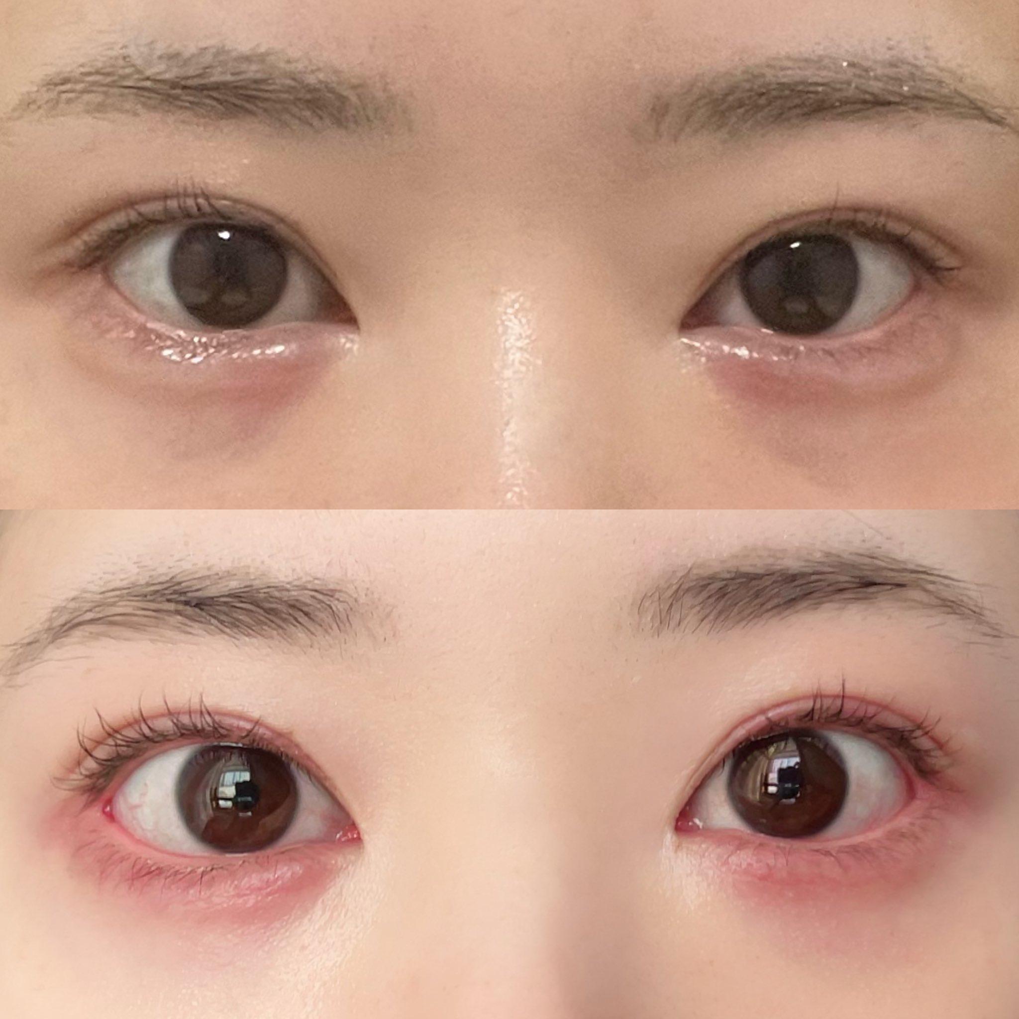 整容|日本網紅Karin砸逾42萬大改造,包括開眼頭及眼尾