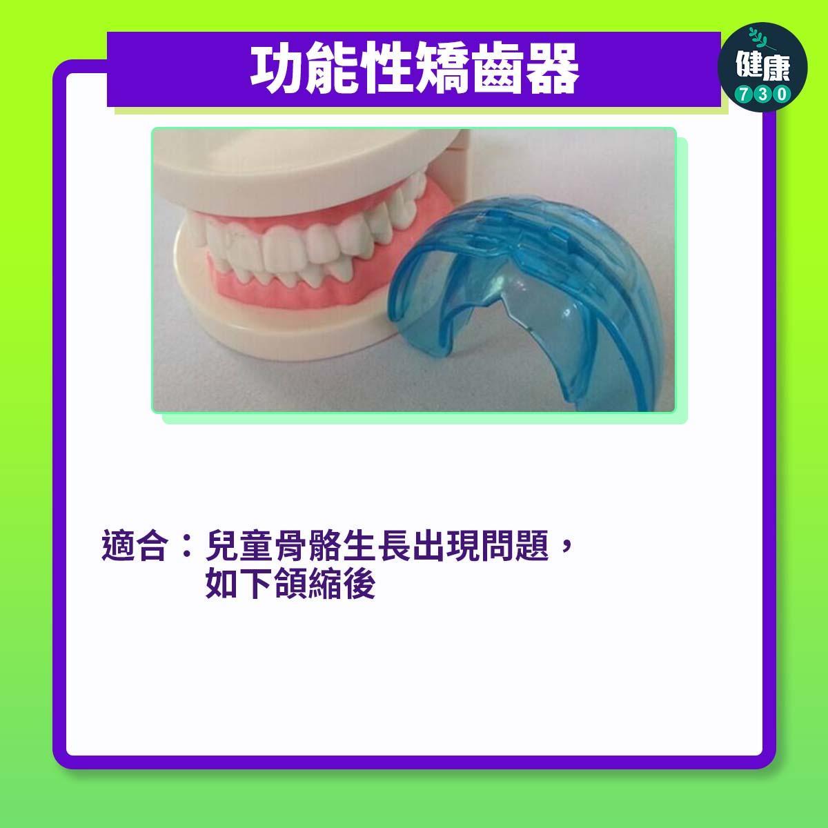 牙齒矯正|3個箍牙方法(am730製圖)