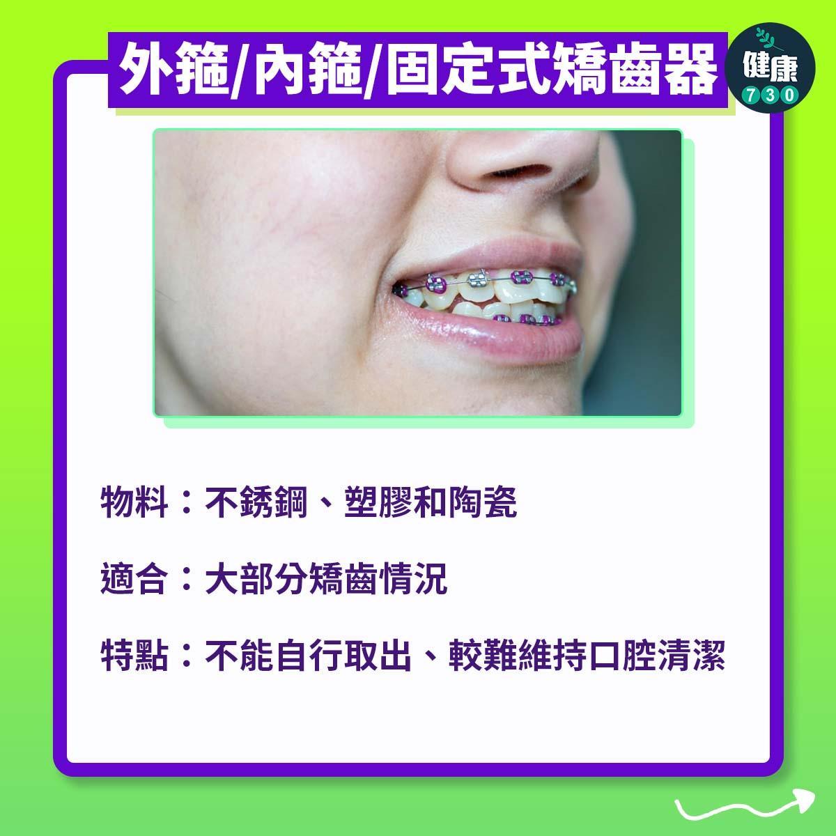 牙齒矯正|3個箍牙方法(am730製圖)