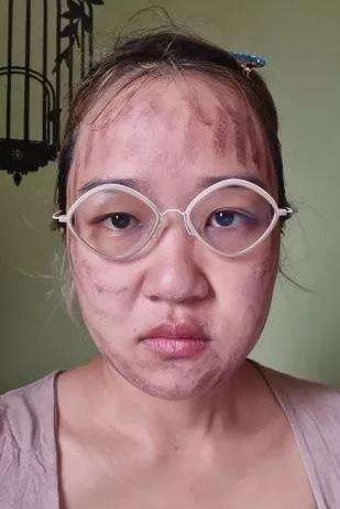 伊薩達臉上留下血痕,影響儀容。(互聯網)