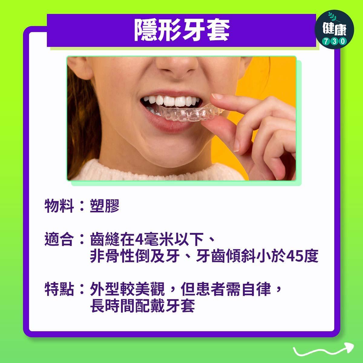 牙齒矯正|3個箍牙方法(am730製圖)