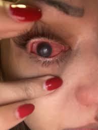 醫生:即使接受角膜手術,也不保證恢復視力。(X)