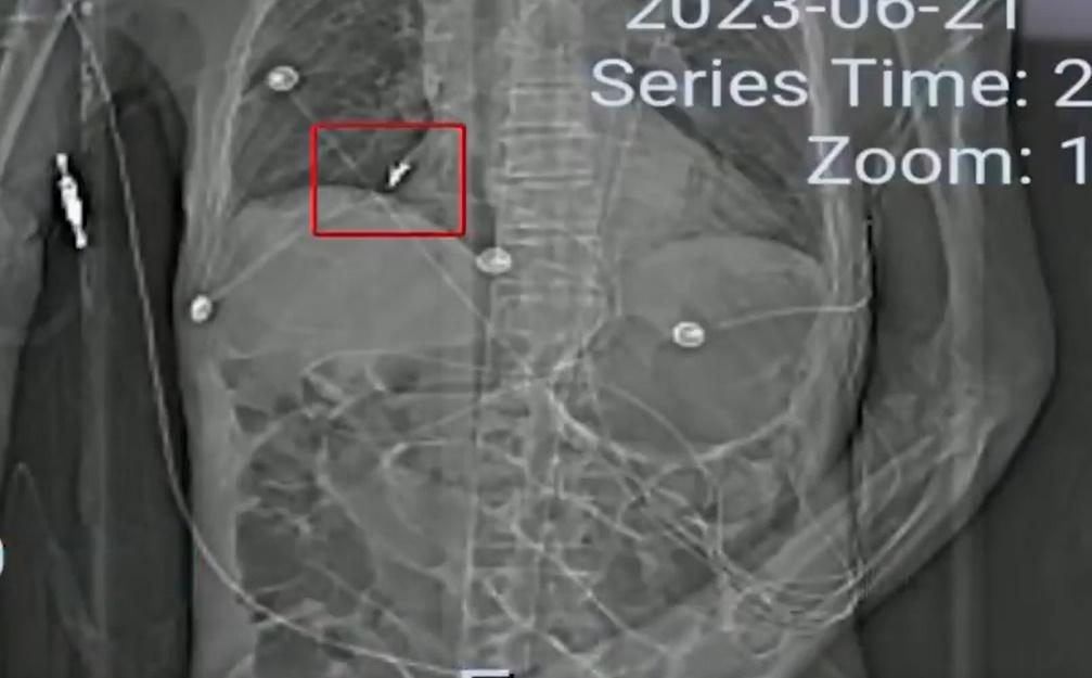 直到老翁臨終,肺裡的牙都未取出。(微博)