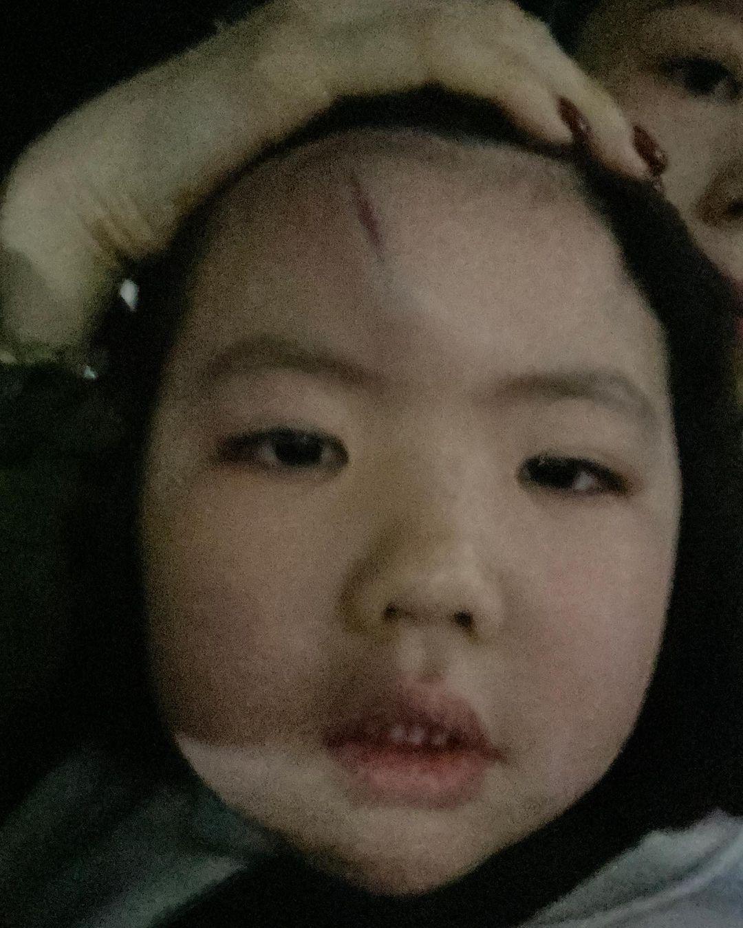 李璨琛同太太梁志瑩嘅5歲大女李元元(Lucy)因家居意外撞傷前額(李元元IG)