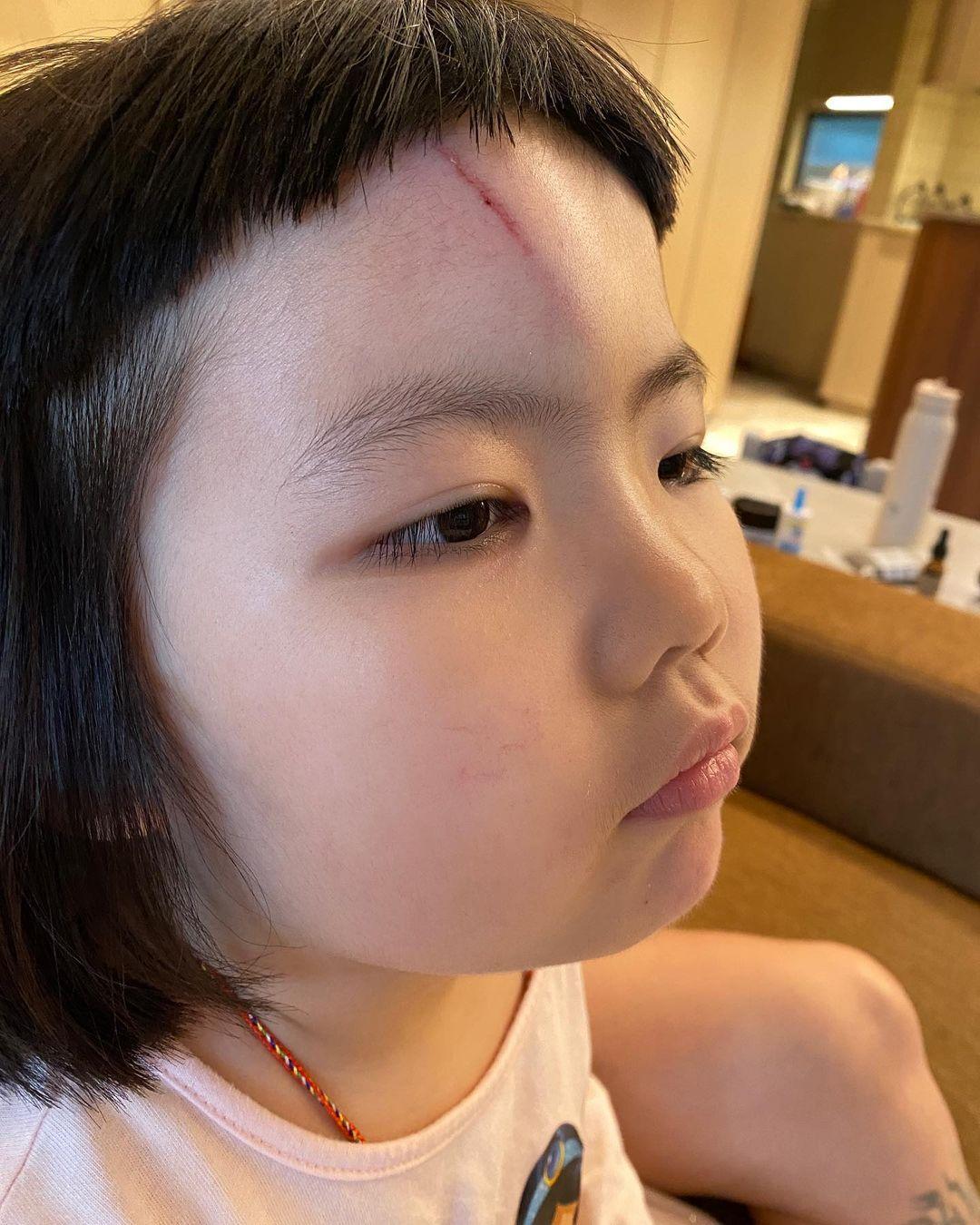 李璨琛同太太梁志瑩嘅5歲大女李元元(Lucy)因家居意外撞傷前額(李元元IG)