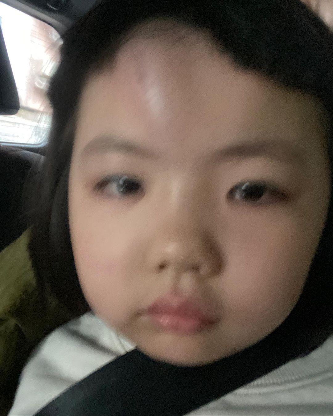 李璨琛同太太梁志瑩嘅5歲大女李元元(Lucy)因家居意外撞傷前額(李元元IG)