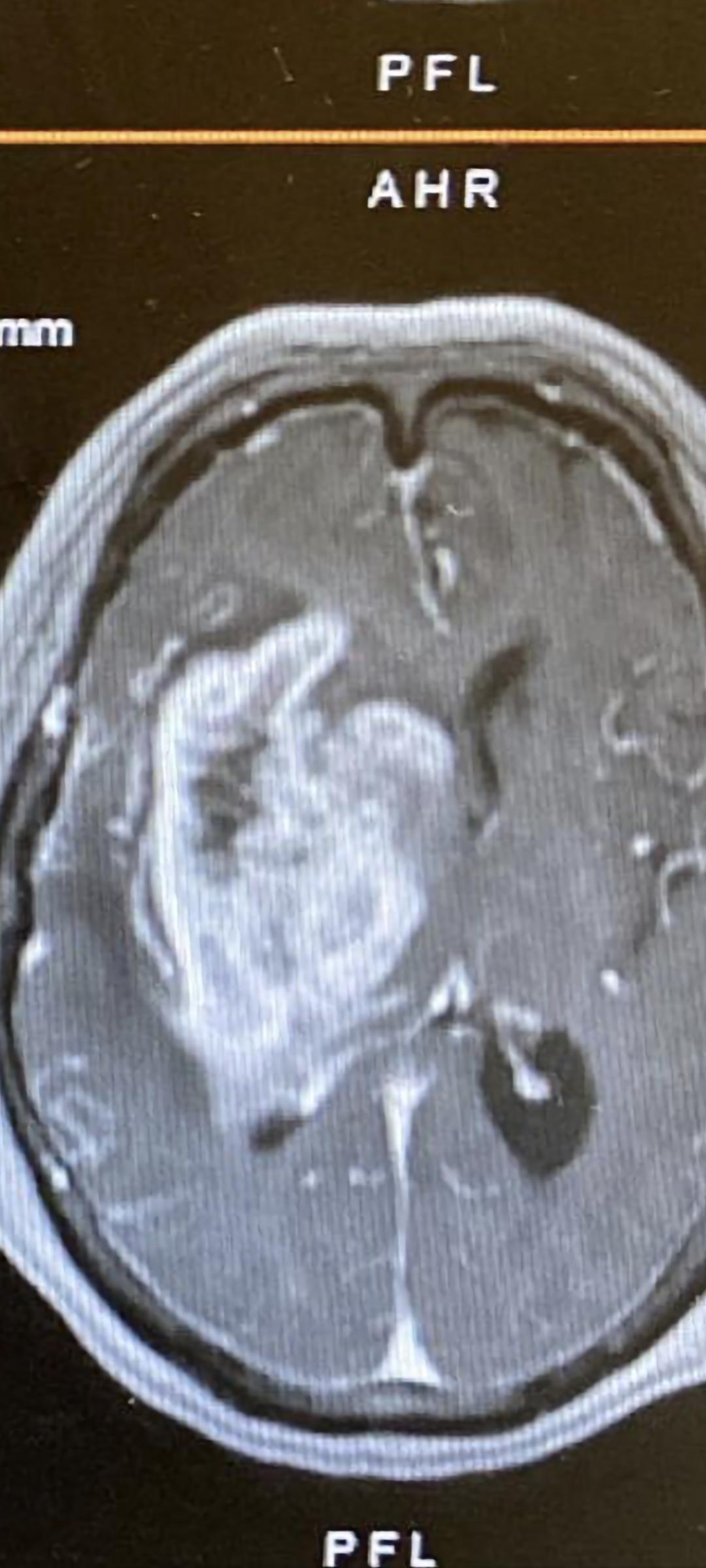 是右腦一個體積容量很大的惡性膠質瘤的磁力共振掃描