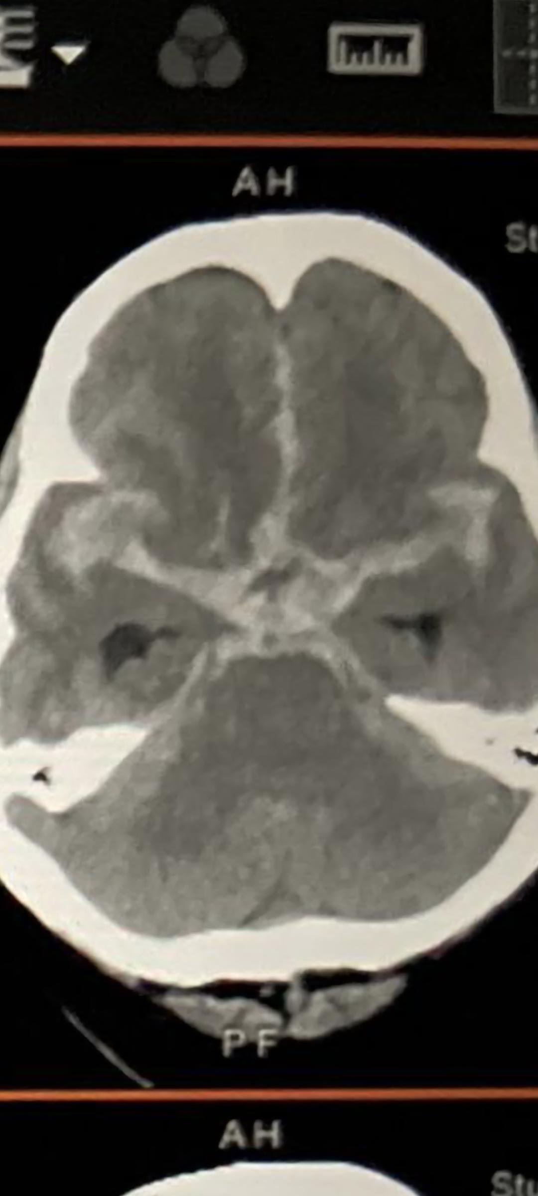 是急性蜘蛛膜下腔出血和急性腦積水的電腦掃描