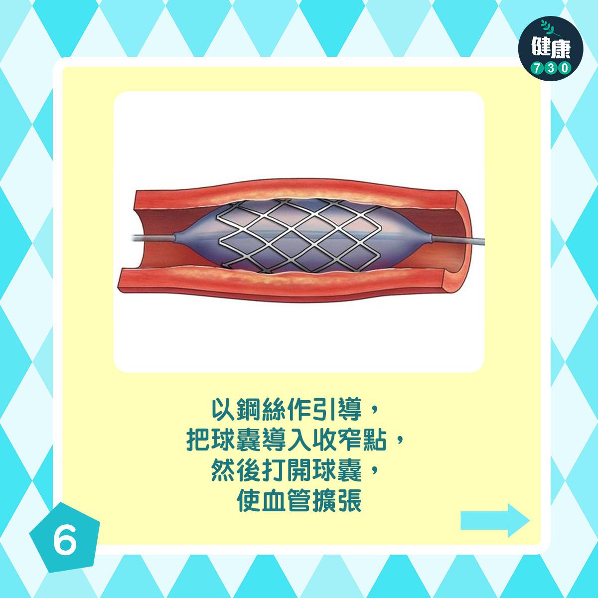 通波仔手術過程