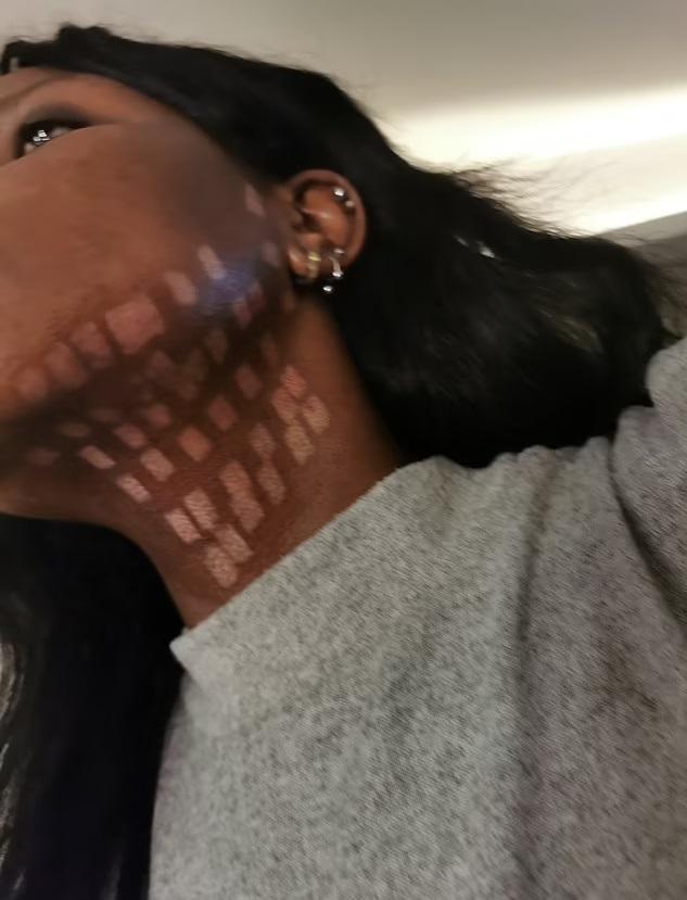 莫約頸部皮膚燒傷的部分脫皮後,呈現出一個個方格。(互聯網)