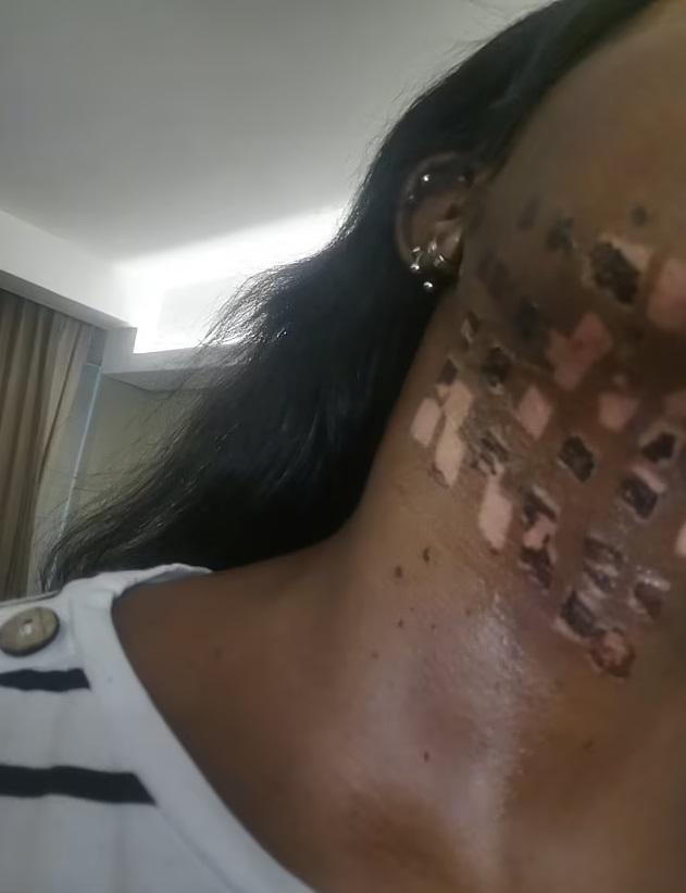 莫約頸部皮膚燒傷的部分逐漸脫皮。(互聯網)