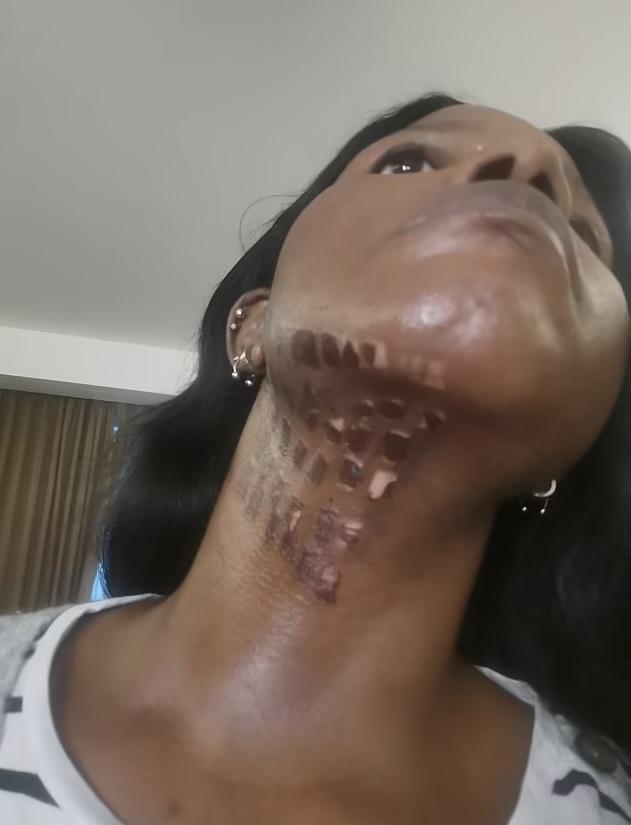 莫約頸部皮膚燒傷的部分逐漸脫皮。(互聯網)