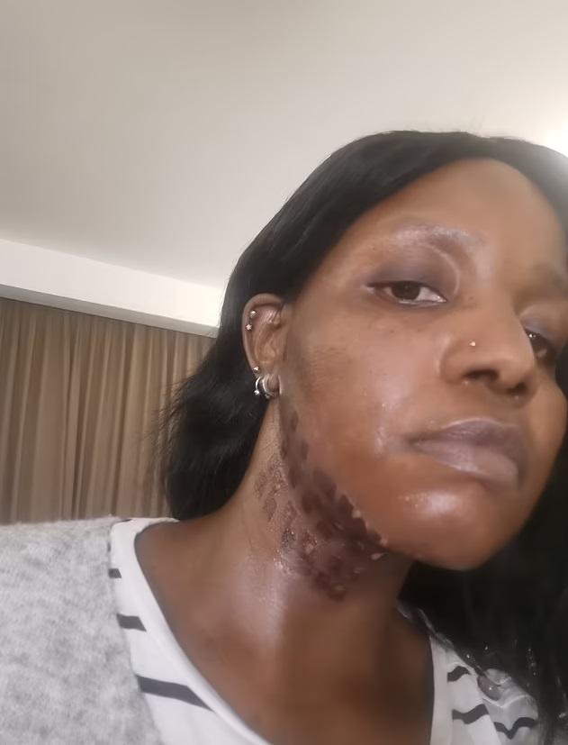 莫約頸部皮膚燒傷的部分開始脫皮。(互聯網)