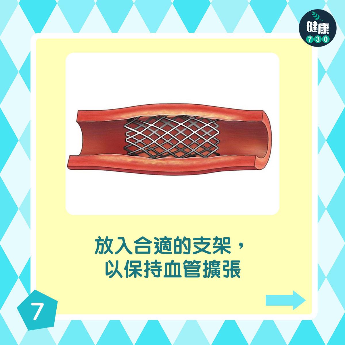 通波仔手術過程