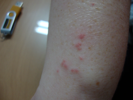 南韓全國多處報告發現床蝨。(網上圖片)