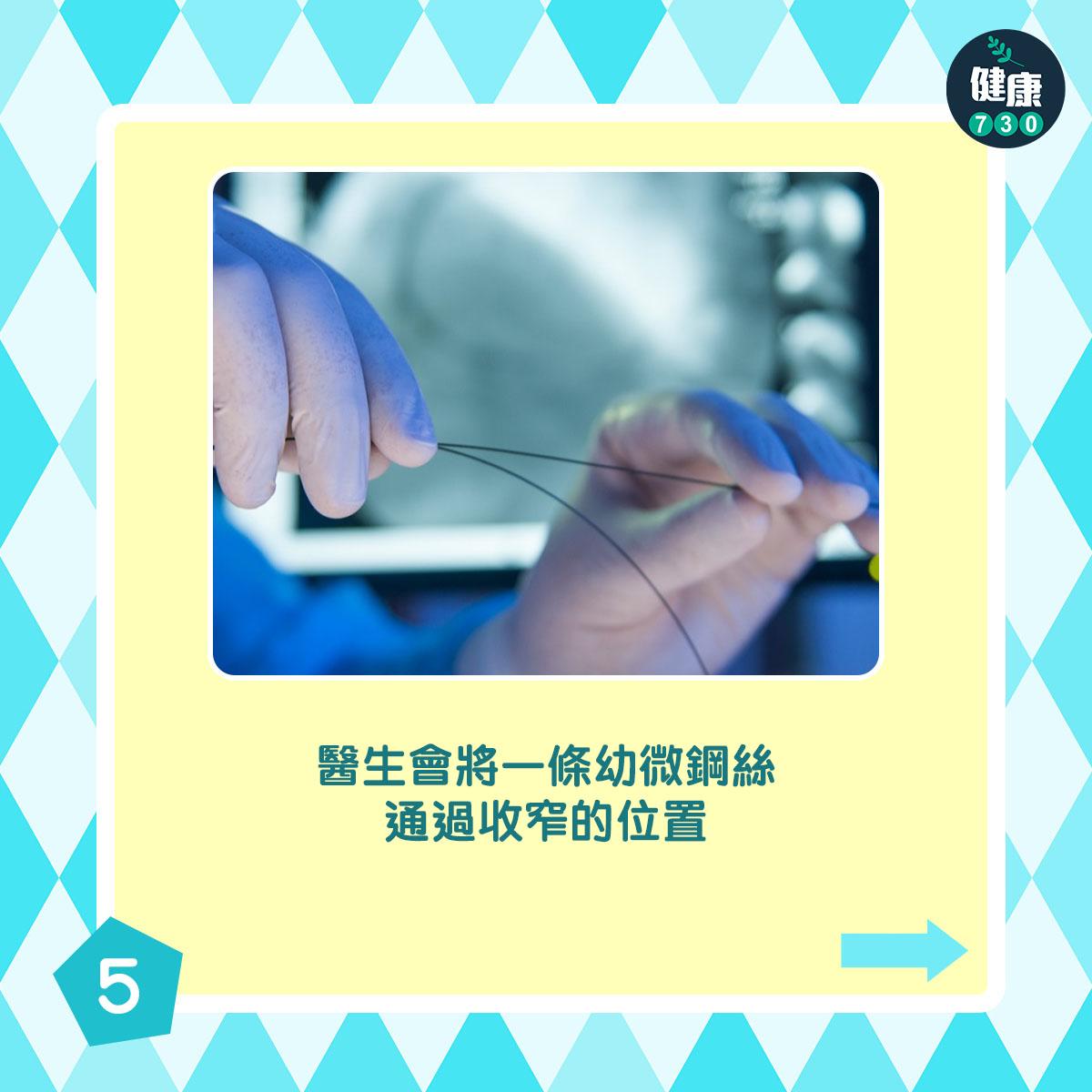 通波仔手術過程