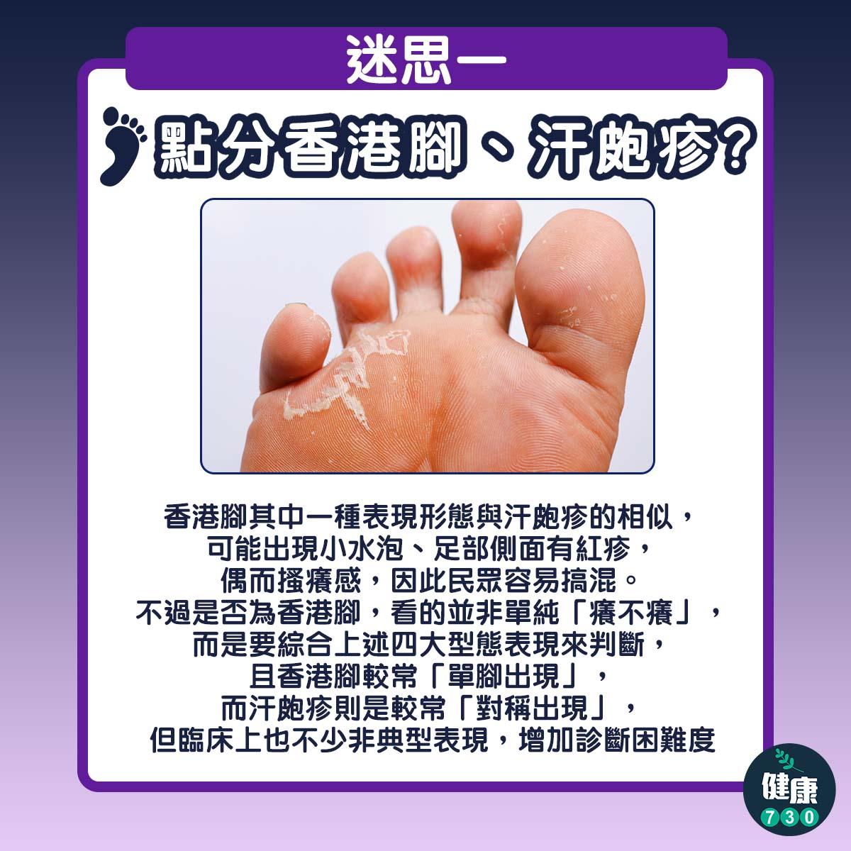 香港腳治療|搽藥膏、著涼鞋無效?破解足癬3大迷思
