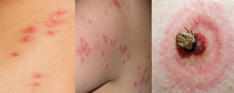 南韓床蝨|港府指床蝨非重要病患 稍後公布預防及處理方法