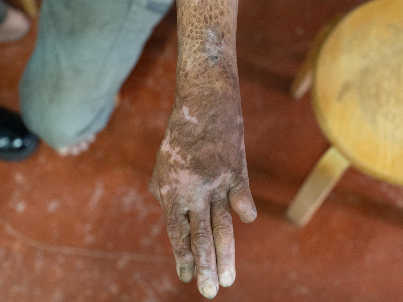 修例風波|馬鞍山燒人案李伯中風 葛珮帆呼籲市民千萬不要忘記