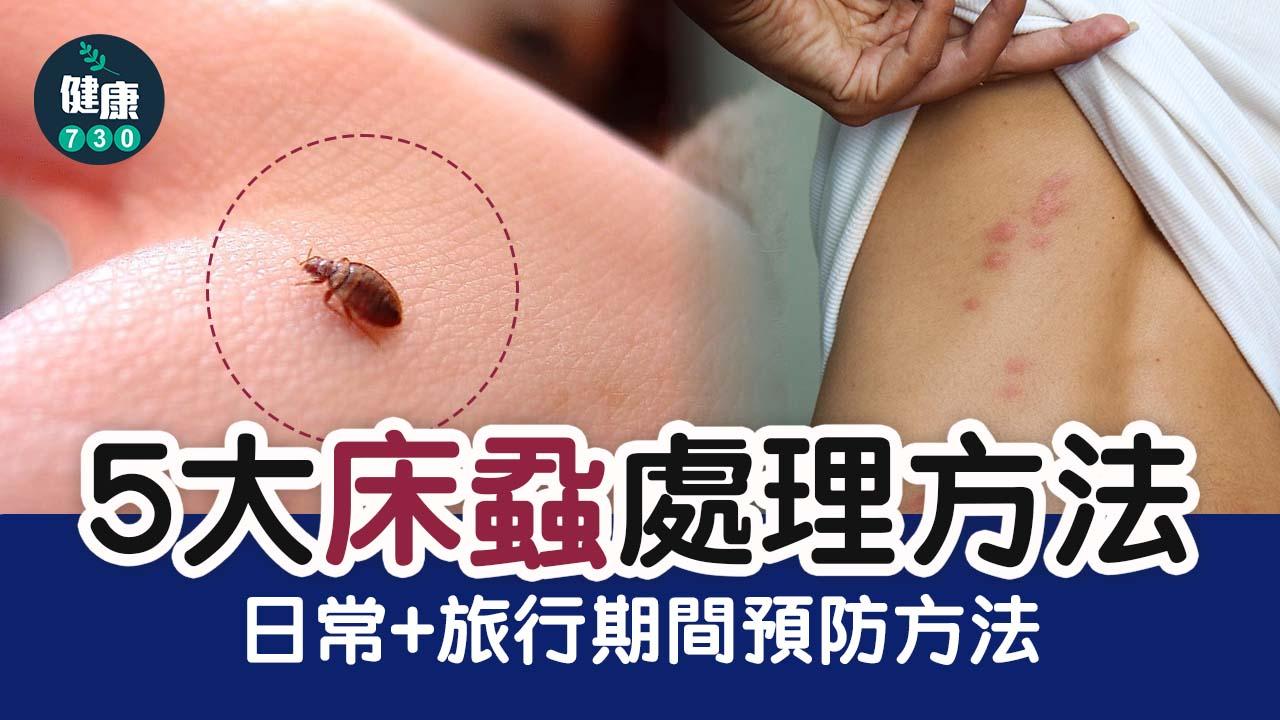 床蝨傷口咬痕特徵係點?5大防床蝨處理方法 及10個日常+旅行貼士