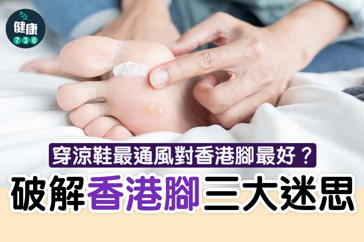 香港腳治療|搽藥膏、著涼鞋無效?破解足癬3大迷思
