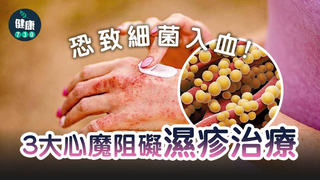 濕疹治療心魔 恐致細菌入血
