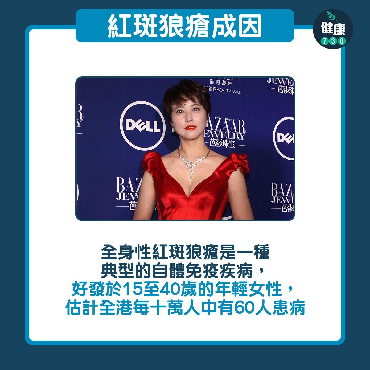 紅斑狼瘡症狀及成因