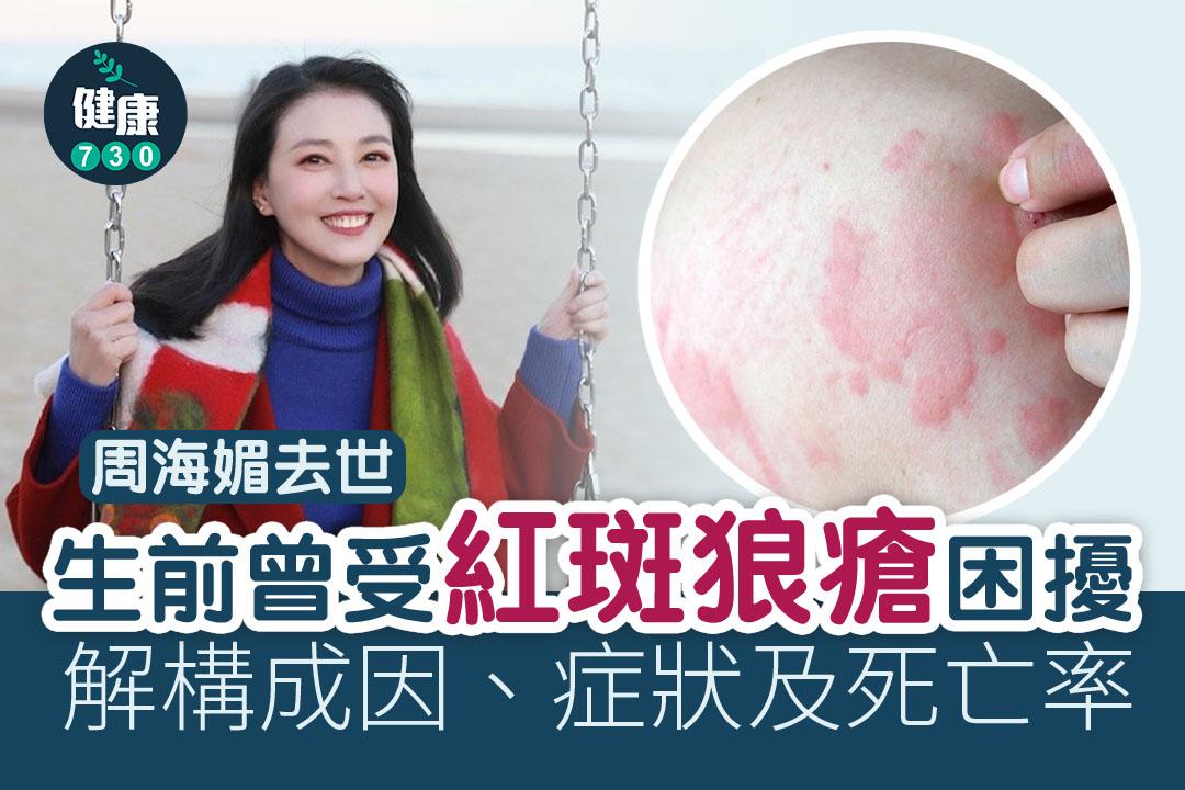 紅斑狼瘡症狀及成因