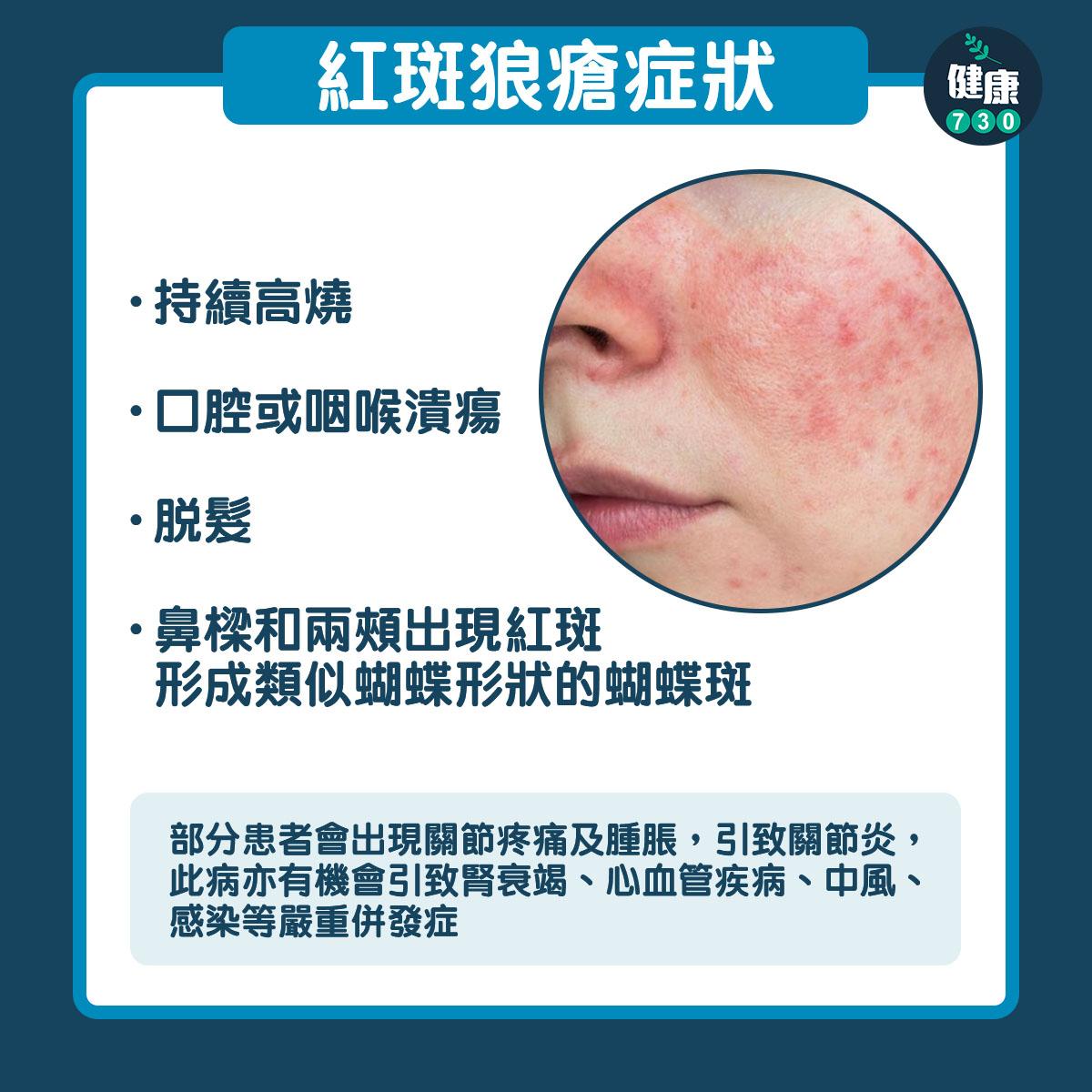 紅斑狼瘡症狀及成因