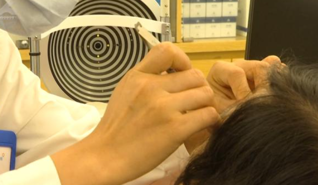 雲南昆明一名女子近日眼睛不舒服,揉眼時竟掉出一條蟲在手上爬,她大驚趕赴醫院就診。醫生檢查時翻開眼皮,能看到一條條絲線樣的白色寄生蟲不停地蠕動,最終從右眼取出40多隻蟲子,左眼取出10多條。