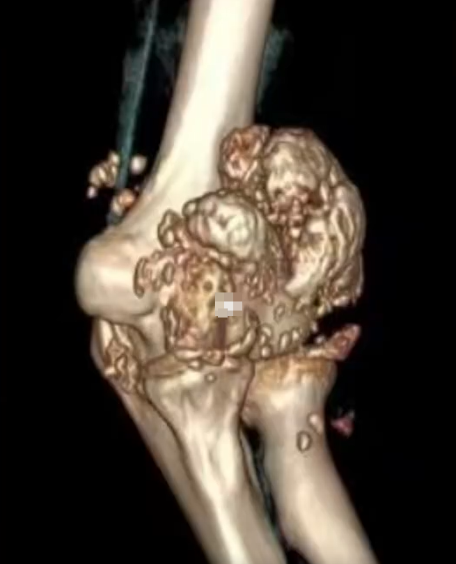 長沙26歲男每日熬夜打機10小時 手肘生出過千粒「珍珠」