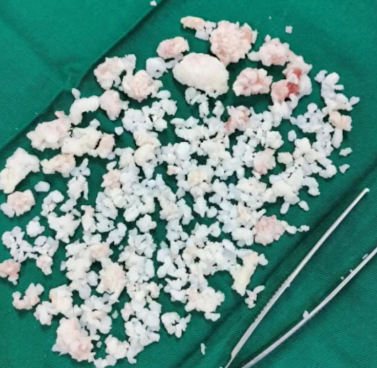 長沙26歲男每日熬夜打機10小時 手肘生出過千粒「珍珠」