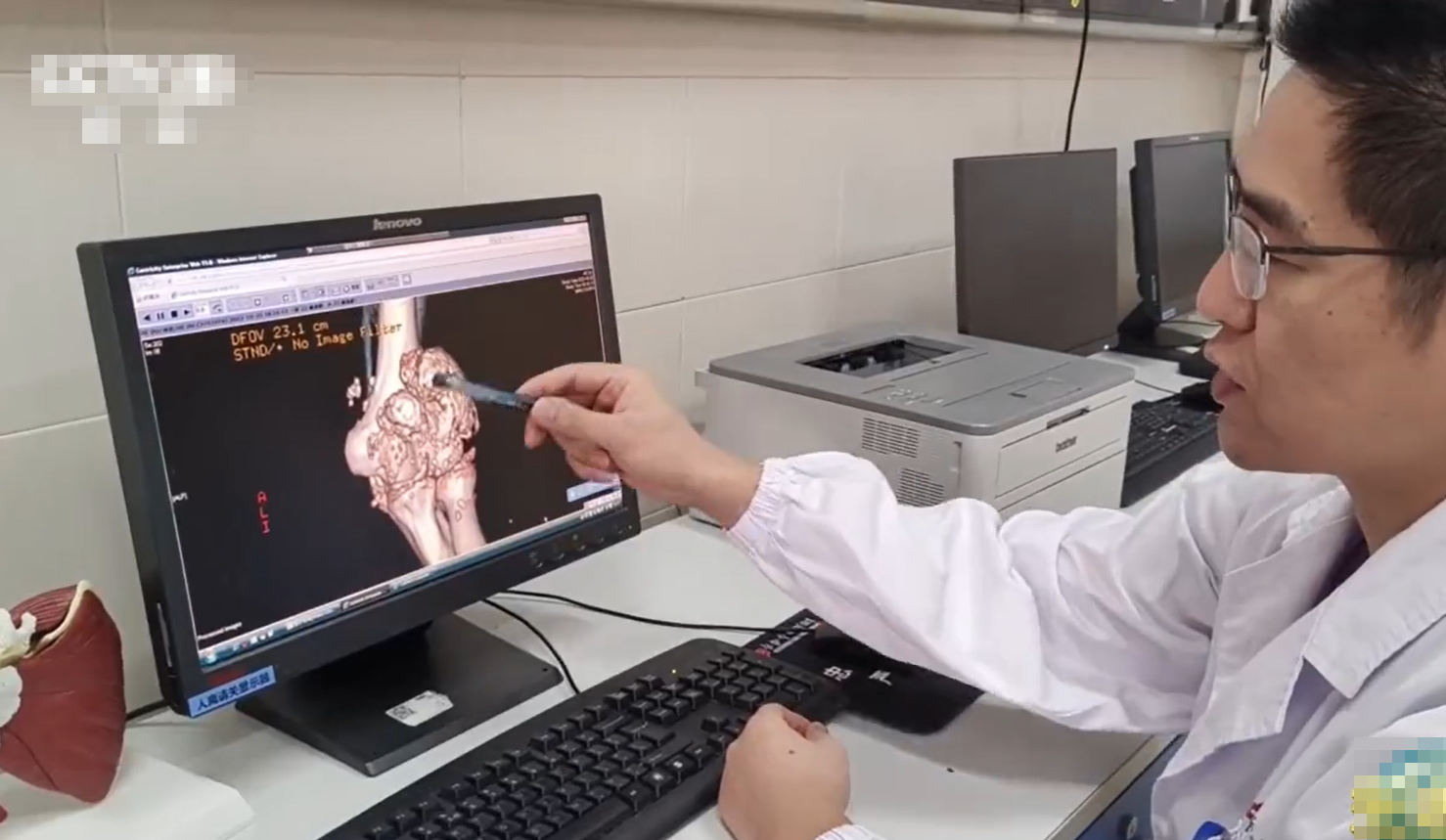 長沙26歲男每日熬夜打機10小時 手肘生出過千粒「珍珠」