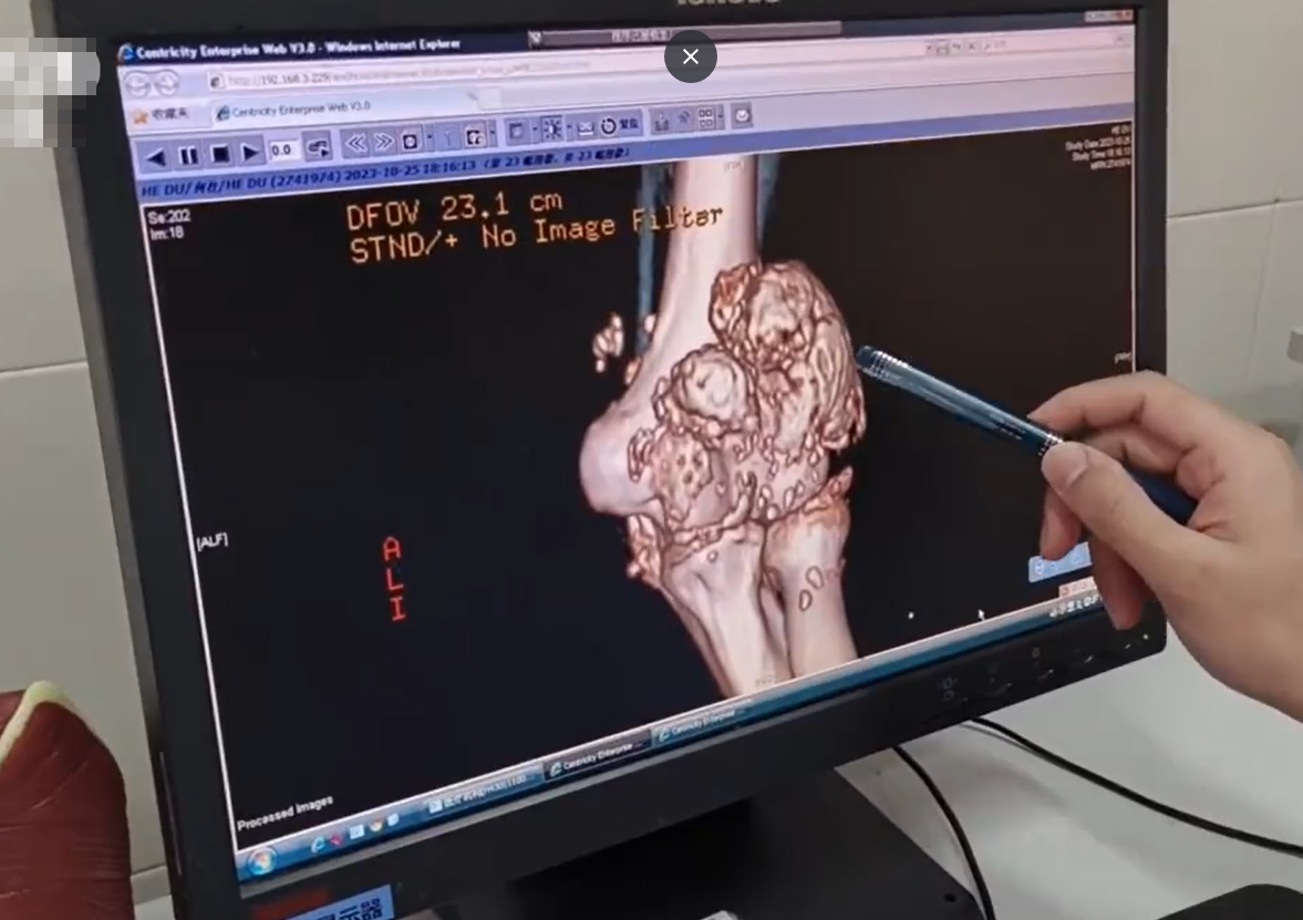 長沙26歲男每日熬夜打機10小時 手肘生出過千粒「珍珠」