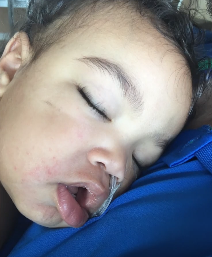 女嬰Kipley Haugen於2017年誤吃水珠後入院。(互聯網)