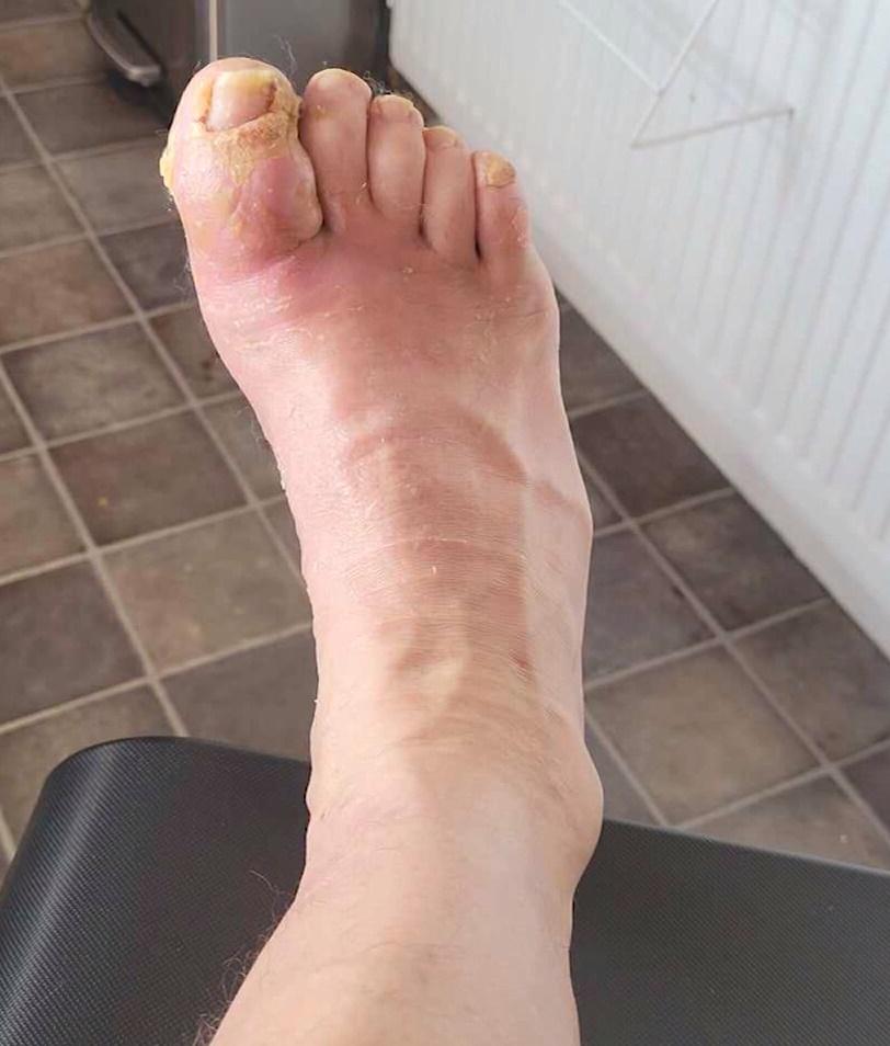 腳趾康復中。(網上圖片)