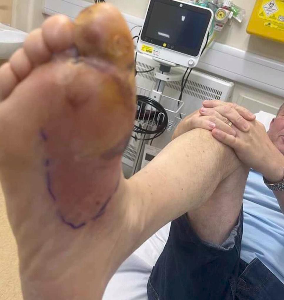 Colin Blake接受治療。(網上圖片)