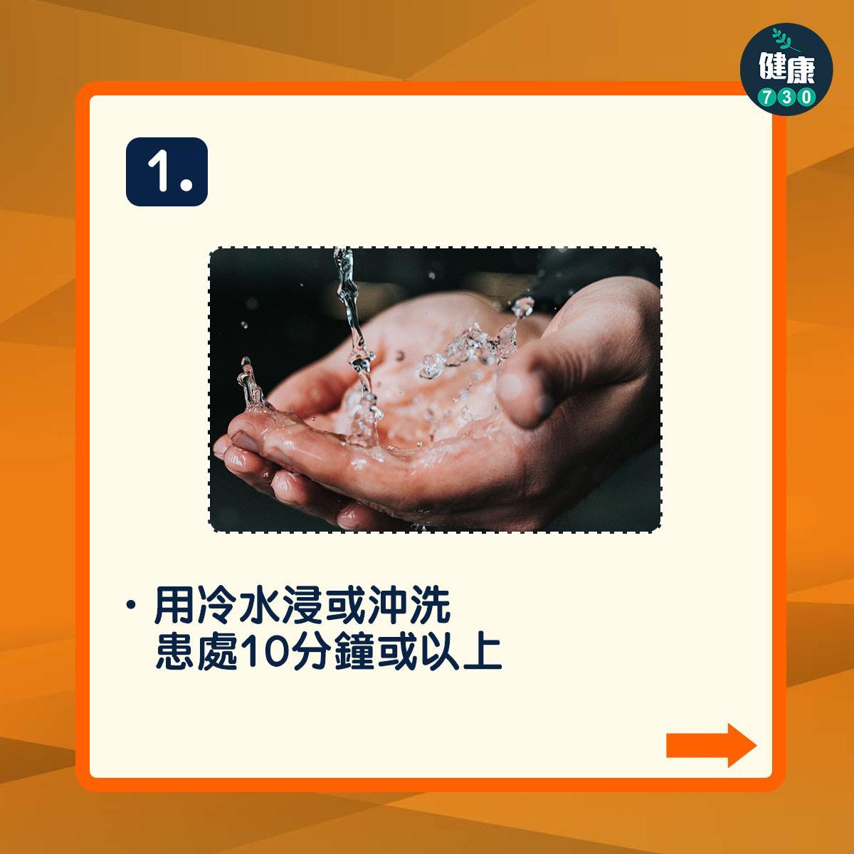 燒燙傷處理方法(am730製圖)