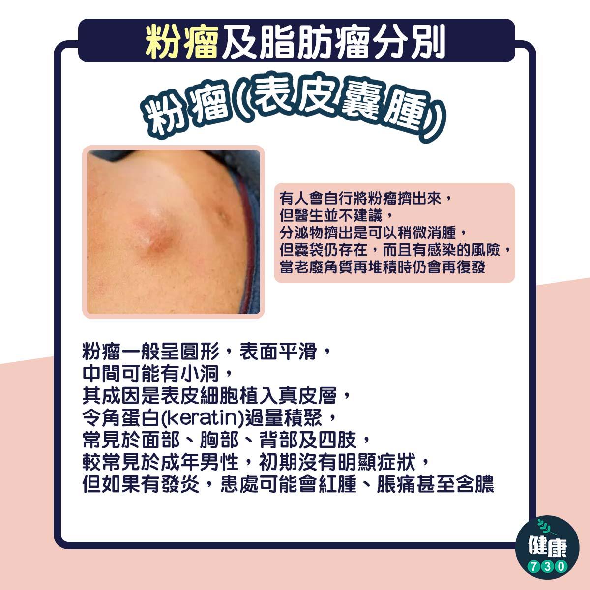 粉瘤與脂肪瘤分別,手術切除與否評估(am730製圖)