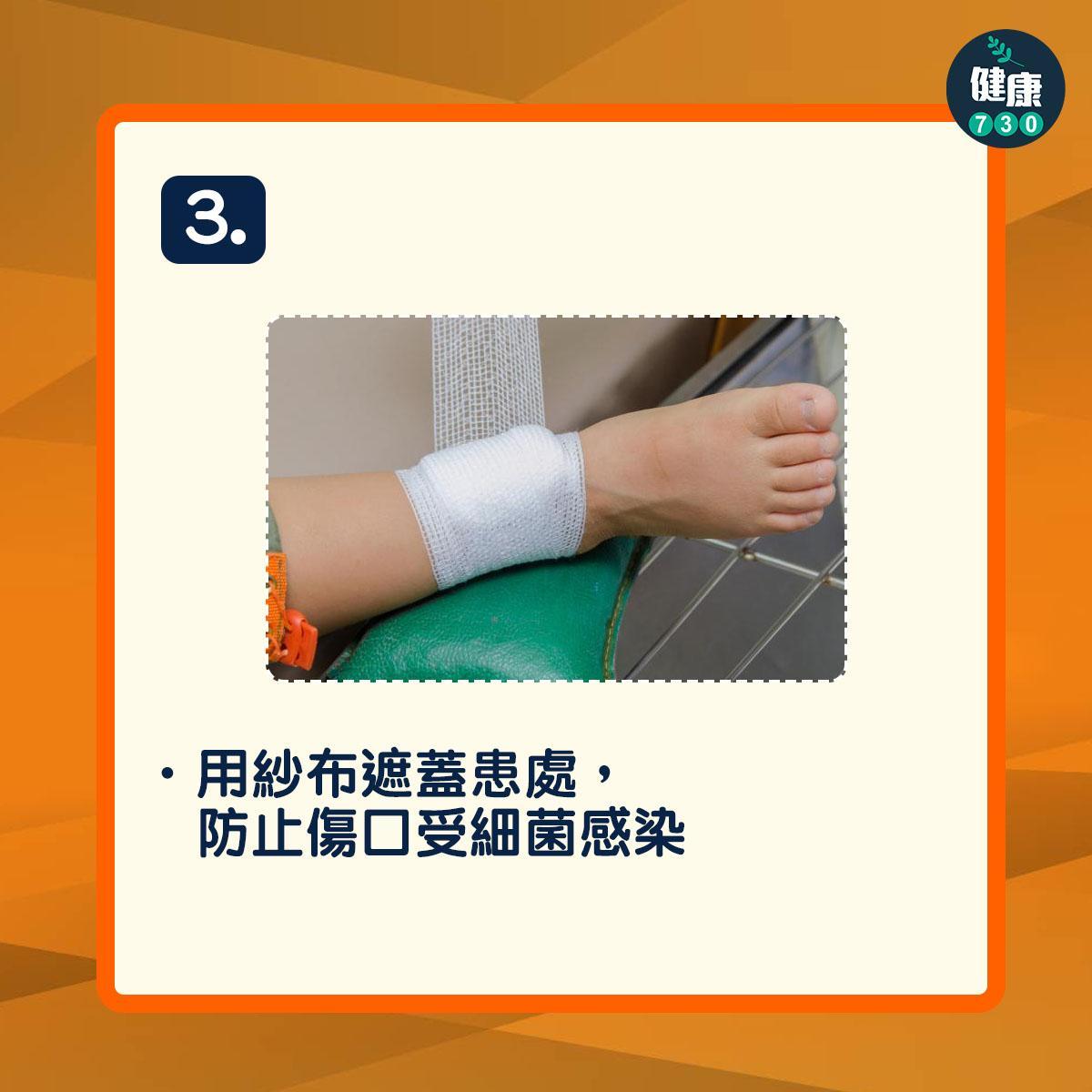 燒燙傷處理方法(am730製圖)