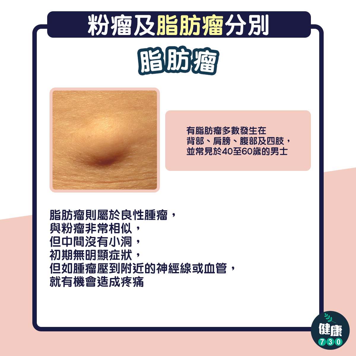 粉瘤與脂肪瘤分別,手術切除與否評估(am730製圖)