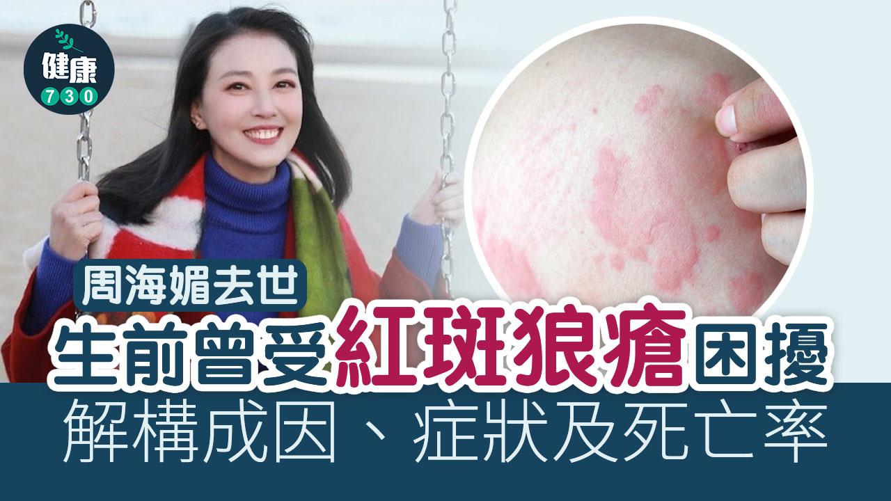 有傳周海媚的死因與紅斑狼瘡症有關。